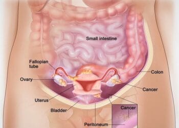 ovarian tumor cyst cancer symptoms, ultrasound, Ovarian cancer survival rate