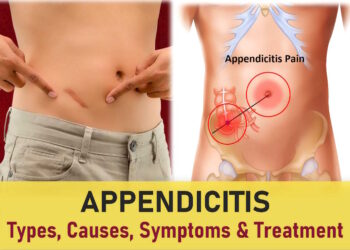 Appendicitis symptoms, What side is your appendix on, appendix pain location, Appendicitis scar