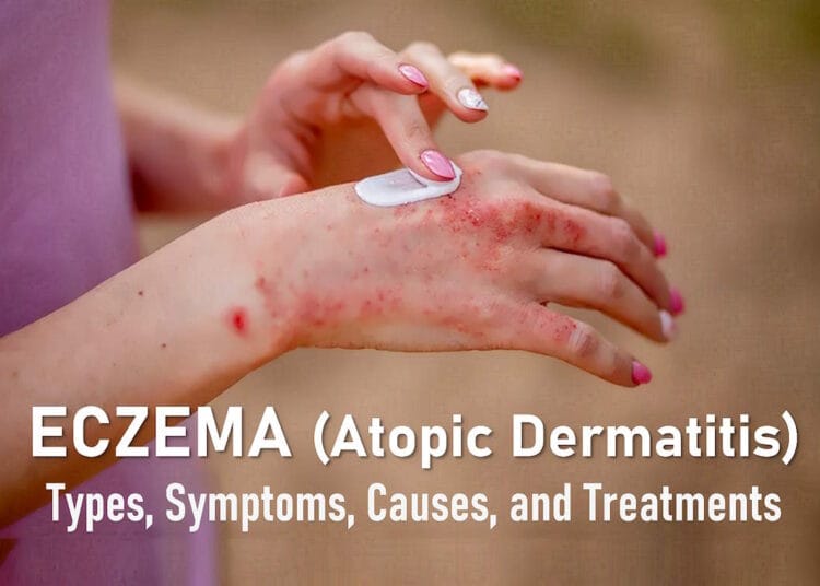 eczema rash, Dyshidrotic eczema, Nummular eczema, Psoriasis vs eczema, causes, treatment, cream, pictures