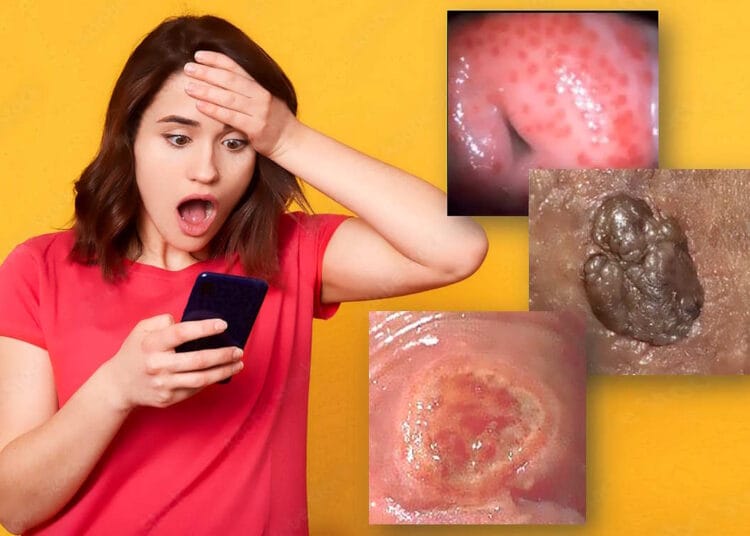 blue waffle disease picture twitter original std