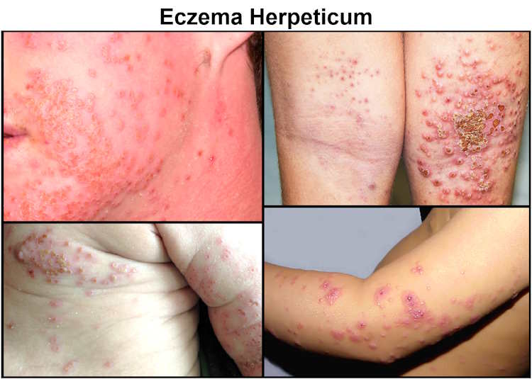 eczema herpeticum pictures, treatment, eczema herpeticum vs impetigo, eczema herpeticum stages
