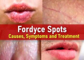 fordyce spots on lips, penis, labia, vagina, balls, male, female, pictures
