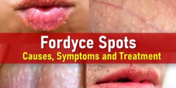 fordyce spots on lips, penis, labia, vagina, balls, male, female, pictures
