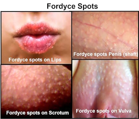 fordyce spots on lips, penis, labia, vagina, male, female, pictures