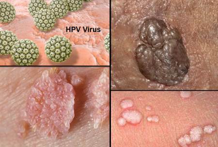 human papillomavirus HPV pictures HPV Warts women, blue waffle