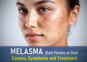 How to get rid of melasma, Best treatment for melasma on face, Melasma symptoms