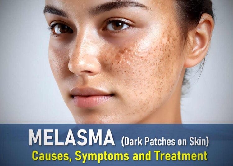 How to get rid of melasma, Best treatment for melasma on face, Melasma symptoms
