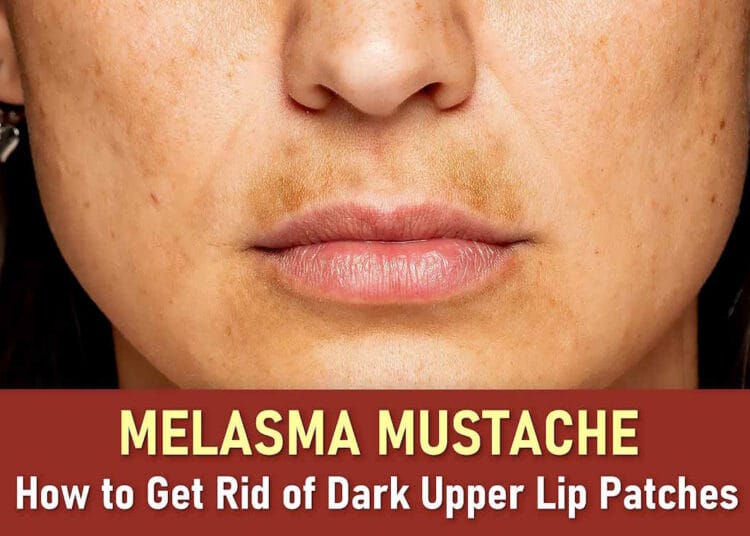 melasma mustache treatment, melasma mustache natural treatment at home