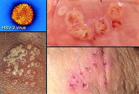 blue waffle disease picture twitter original std