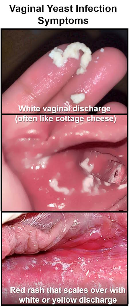 yeast infection discharge, yeast infection discharge look like, yeast infection sores pictures, yeast infection bumps