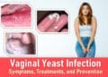 vaginal yeast infection symptoms, treatment, medication, yeast infection discharge pictures, yeast infection sores pictures, yeast infection bumps