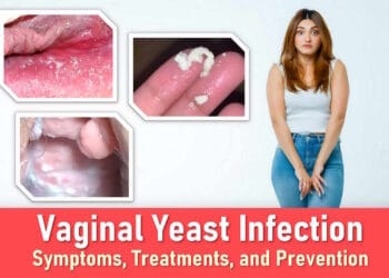 vaginal yeast infection symptoms, treatment, medication, yeast infection discharge pictures, yeast infection sores pictures, yeast infection bumps