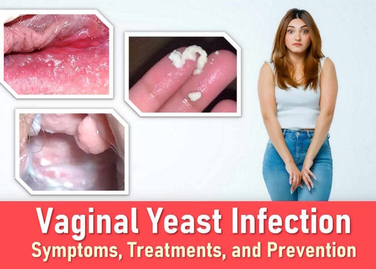 vaginal yeast infection symptoms, treatment, medication, yeast infection discharge pictures, yeast infection sores pictures, yeast infection bumps