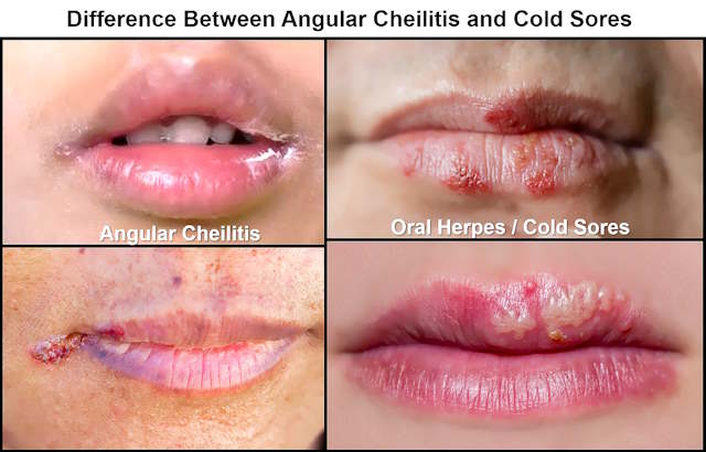 angular cheilitis vs cold sore pictures, sores corner of mouth, angular cheilitis vs oral herpes
