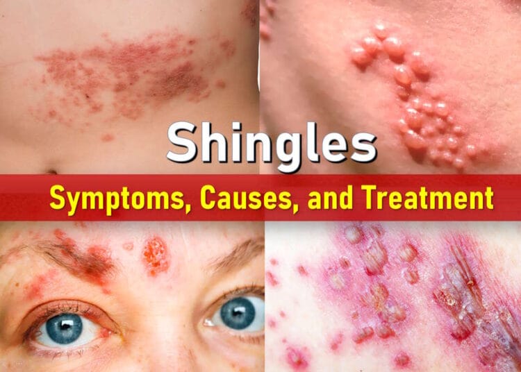 pictures of shingles, stages of shingles rash pictures, shingles on face, mild shingles rash symptoms