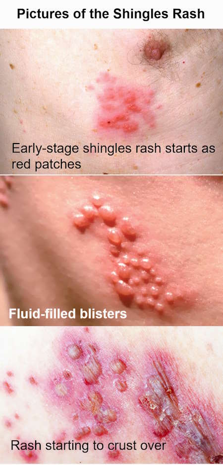pictures of shingles, stages of shingles rash pictures, mild shingles rash pictures