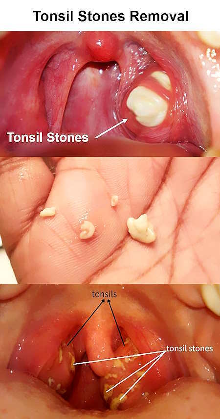 what causes tonsil stones, how to remove tonsil stones, Tonsil stones pictures