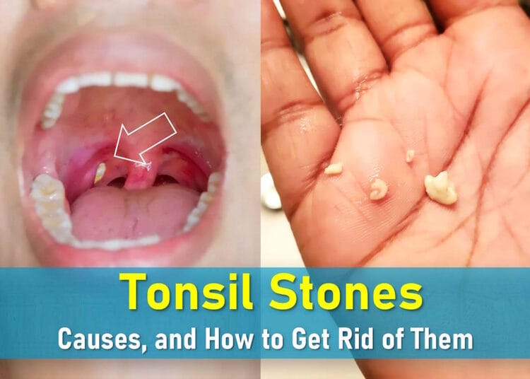 what causes tonsil stones, how to remove tonsil stones, causes, prevent