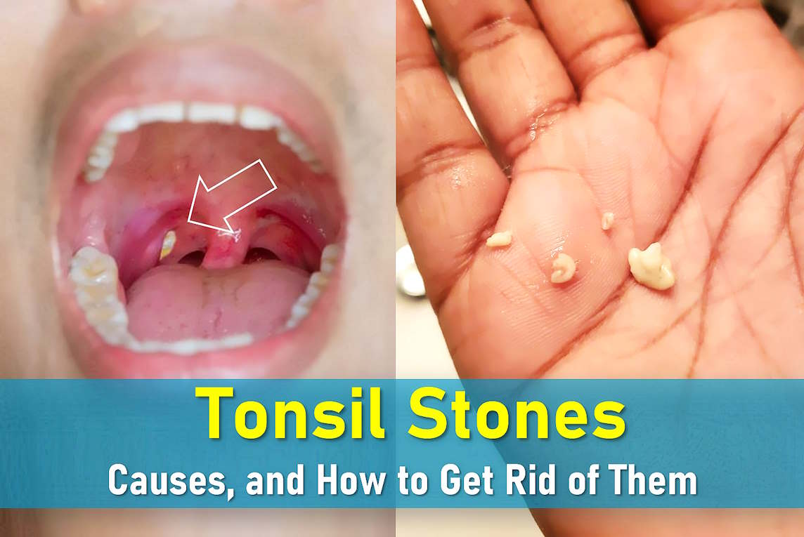 What Causes Tonsil Stones Symptoms And How To Get Rid Of Them What Causes Tonsil Stones Symptoms And How To Get Rid Of Them