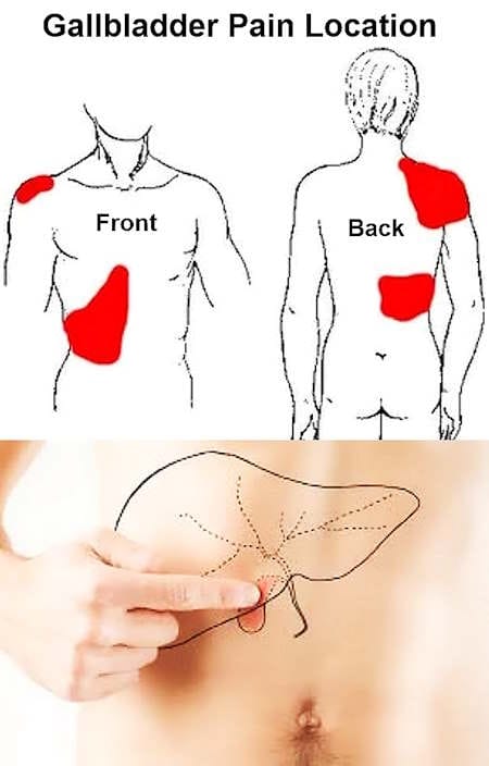 gallbladder pain location female, what does gallbladder pain feel like symptoms