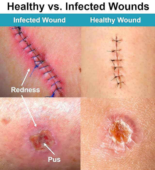 What does an infected cut look like, healthy vs infected wound, what does an infected wound look like