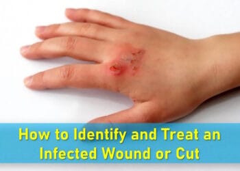 What does an infected cut look like, Wound infection symptoms, Signs of healing wound, treatment