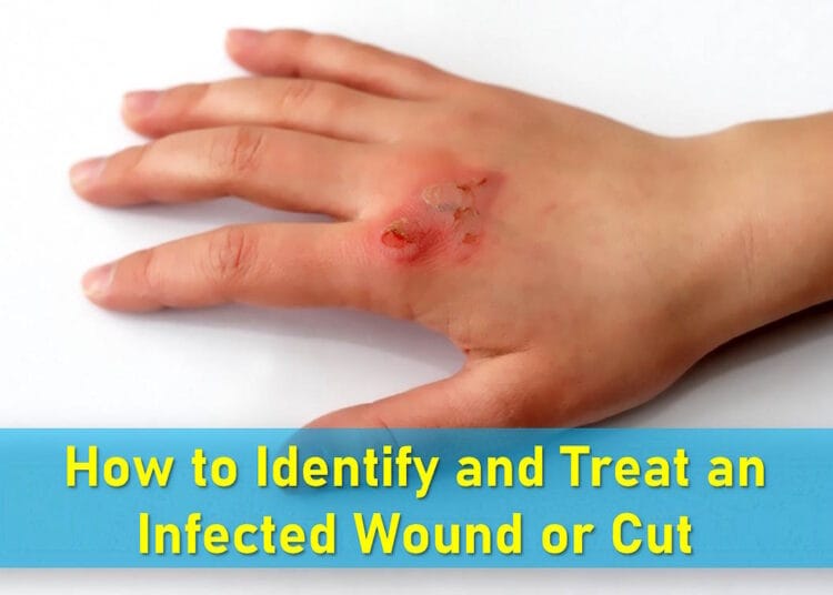 What does an infected cut look like, Wound infection symptoms, Signs of healing wound, treatment