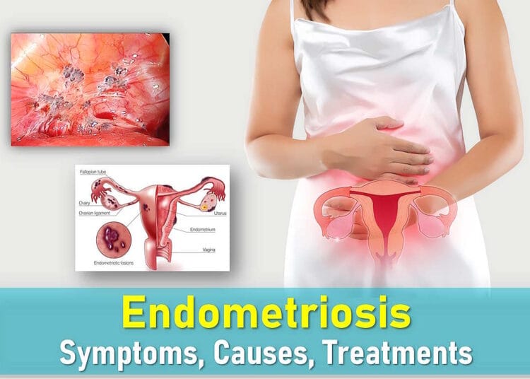 endometriosis symptoms, endometriosis treatments, stage 4 endometriosis, stage 2 endometriosis, endometriosis pictures