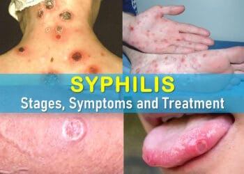 syphilis photos, syphilis rash, syphilis sore, secondary syphilis, syphilis symptoms in females, tertiary syphilis