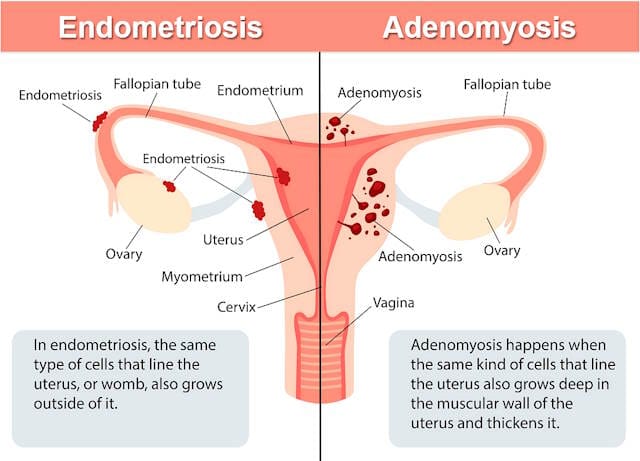 adenomyosis vs endometriosis symptoms, difference between endometriosis and adenomyosis, pain, fibroids