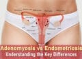 adenomyosis vs endometriosis symptoms, difference between endometriosis and adenomyosis, pain, fibroids