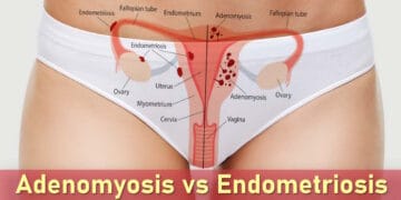 adenomyosis vs endometriosis symptoms, difference between endometriosis and adenomyosis, pain, fibroids