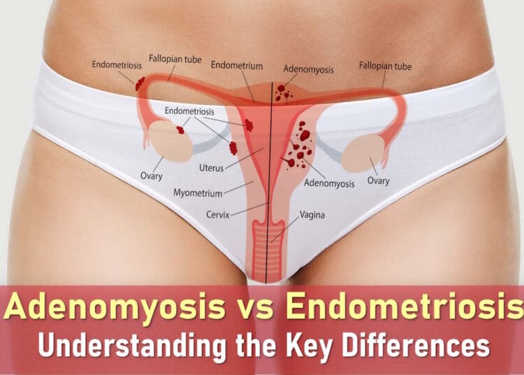 adenomyosis vs endometriosis symptoms, difference between endometriosis and adenomyosis, pain, fibroids