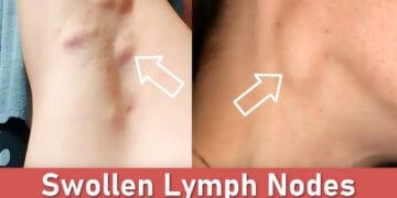swollen lymph nodes, cervical lymph nodes, swollen lymph nodes armpit, occipital lymph nodes, swollen lymph node behind ear