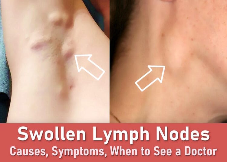 swollen lymph nodes, cervical lymph nodes, swollen lymph nodes armpit, occipital lymph nodes, swollen lymph node behind ear